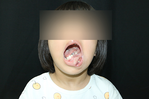 001术前口内照1.jpg 001术前口内照1.jpg